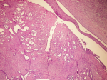 CYSTOSARCOMA PHYLLODES